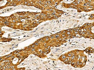 ISG20 Antibody - DF14346 at 1/100 staining human esophageal cancer by IHC-P.