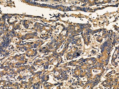 ChT1 Antibody - DF14348 at 1/100 staining human prostate cancer by IHC-P.