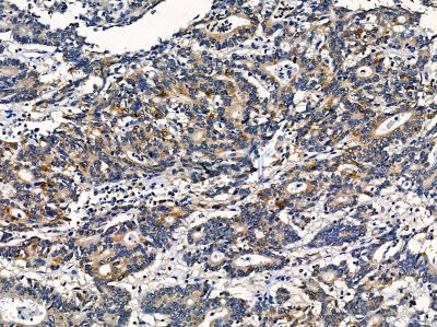 TPD52 Antibody - DF14353 at 1/100 staining human prostate cancer by IHC-P.