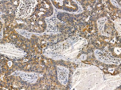 TPD52 Antibody - DF14353 at 1/100 staining human lung cancer by IHC-P.