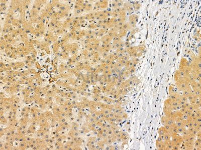 Transglutaminase 7 Antibody - DF14370 at 1/100 staining human prostate cancer and para-carcinoma tissue by IHC-P.