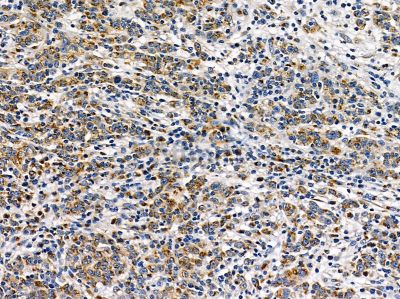 Transglutaminase 7 Antibody - DF14370 at 1/100 staining human gastric cancer by IHC-P.