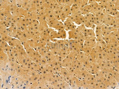 CLEC1B Antibody - DF14376 at 1/100 staining human liver cancer by IHC-P.