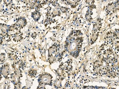 SPNXA Antibody - DF14385 at 1/100 staining human prostate cancer by IHC-P.