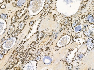 SPNXA Antibody - DF14385 at 1/100 staining human ovarian cancer by IHC-P.