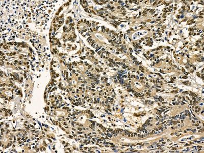 TIP120A Antibody - DF14388 at 1/100 staining human prostate cancer by IHC-P.
