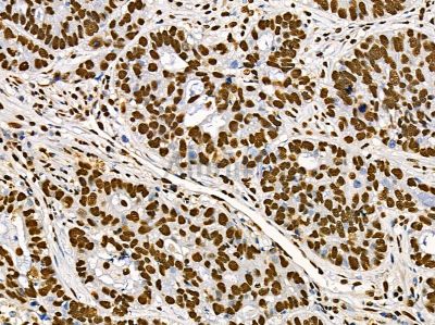 TIP120A Antibody - DF14388 at 1/100 staining human lung cancer and para-carcinoma tissue by IHC-P.