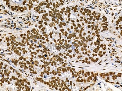 TIP120A Antibody - DF14388 at 1/100 staining human lung cancer by IHC-P.