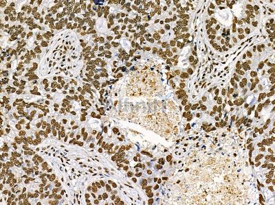 TIP120A Antibody - DF14388 at 1/100 staining human lung cancer by IHC-P.