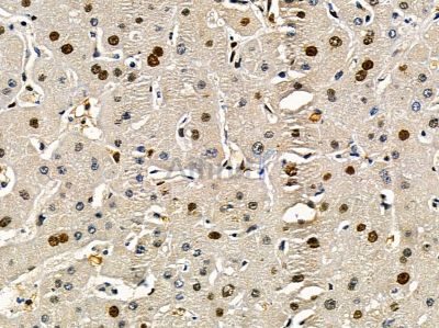 TIP120A Antibody - DF14388 at 1/100 staining human liver cancer by IHC-P.
