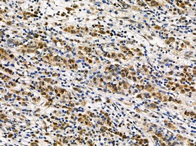 WDR77 Antibody - DF14406 at 1/100 staining human pancreatic cancer by IHC-P.