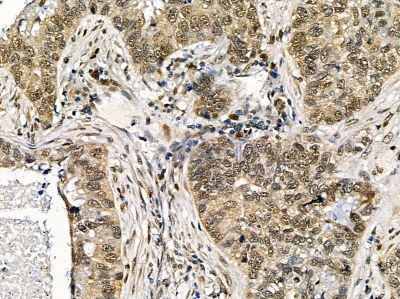WDR77 Antibody - DF14406 at 1/100 staining human lung cancer and para-carcinoma tissue by IHC-P.