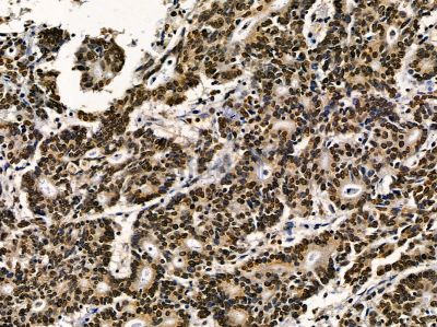 ERRFI1 Antibody - DF14411 at 1/100 staining human colorectal cancer by IHC-P.