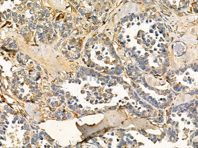 RNF87 Antibody - DF14416 at 1/100 staining human ovarian cancer by IHC-P.