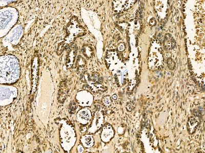 BANF1 Antibody - DF14424 at 1/100 staining human ovarian cancer by IHC-P.