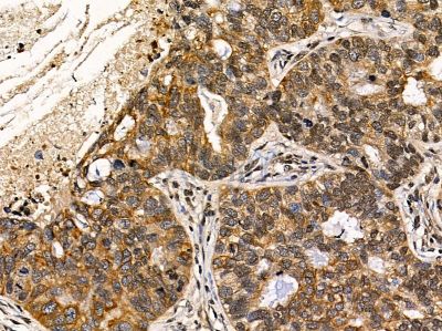 FBXO30 Antibody - DF14441 at 1/100 staining human lung cancer by IHC-P.