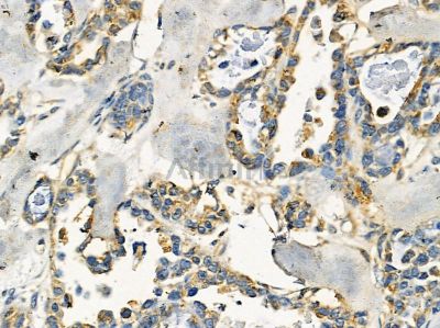 PDZD3 Antibody - DF14442 at 1/100 staining human ovarian cancer by IHC-P.