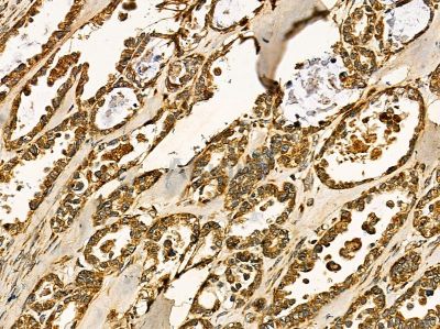 ZNF232 Antibody - DF14445 at 1/100 staining human ovarian cancer by IHC-P.