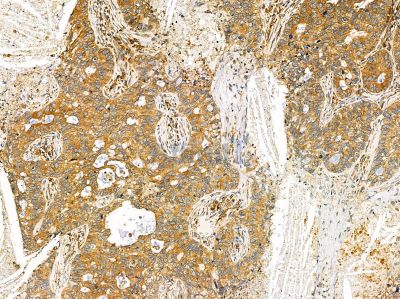 CP2BA Antibody - DF14449 at 1/100 staining human lung cancer and para-carcinoma tissue by IHC-P.