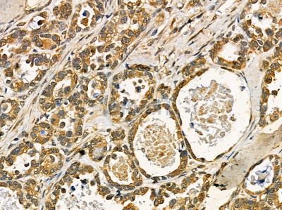 R-spondin1 Antibody - DF14450 at 1/100 staining human ovarian cancer by IHC-P.