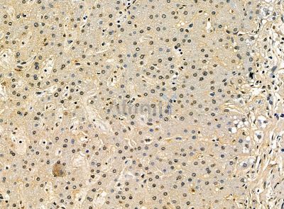 TBX1 Antibody - DF14451 at 1/100 staining human prostate cancer and para-carcinoma tissue by IHC-P.