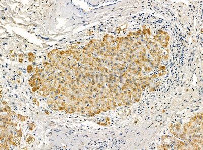 TIFA Antibody - DF14456 at 1/100 staining human prostate cancer and para-carcinoma tissue by IHC-P.