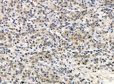 PPME1 Antibody - DF14474 at 1/100 staining human pancreatic cancer by IHC-P.