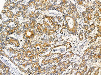 KCTD18 Antibody - DF14533 at 1/100 staining human prostate cancer by IHC-P.