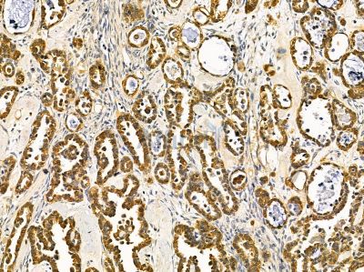 USP4 Antibody - DF14550 at 1/100 staining human ovarian cancer by IHC-P.