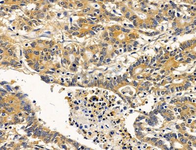 MGAT1 Antibody - DF14556 at 1/100 staining human prostate cancer by IHC-P.