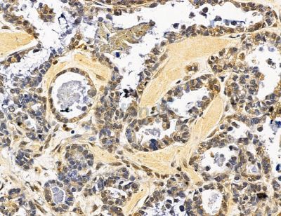 FANCF Antibody - DF14566 at 1/100 staining human ovarian cancer by IHC-P.