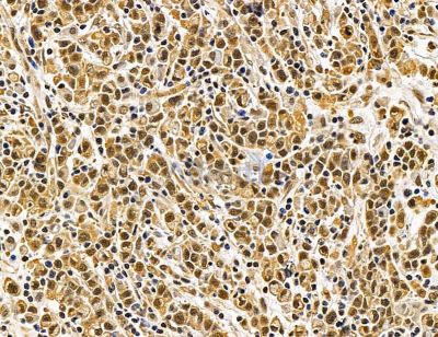 DDX39B Antibody - DF14568 at 1/100 staining human gastric cancer by IHC-P.