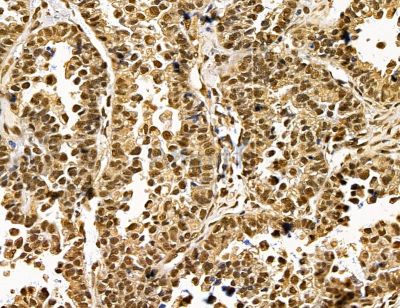 DDX39B Antibody - DF14568 at 1/100 staining human ovarian cancer by IHC-P.