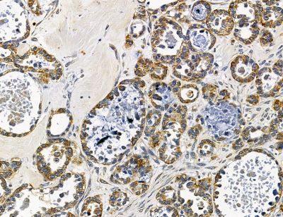 ADAMTS6 Antibody - DF14579 at 1/100 staining human ovarian cancer by IHC-P.