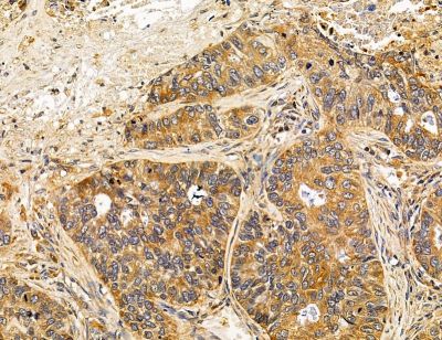 VSIG4 Antibody - DF14591 at 1/100 staining human lung cancer and para-carcinoma tissue by IHC-P.