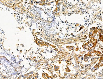 KCNIP2 Antibody - DF14620 at 1/100 staining human pancreatic cancer by IHC-P.