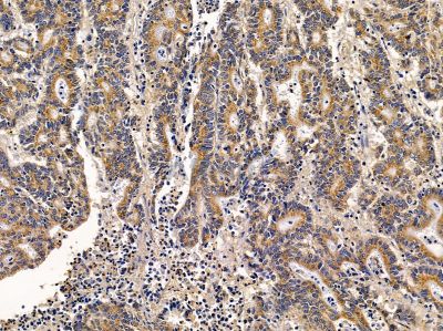 TRDMT1 Antibody - DF14641 at 1/100 staining human colorectal cancer by IHC-P.