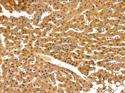 ARHGEF9 Antibody - DF14646 at 1/100 staining human liver cancer by IHC-P.