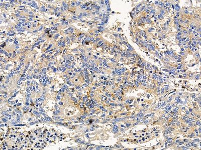 TRIP11 Antibody - DF14653 at 1/100 staining human prostate cancer by IHC-P.