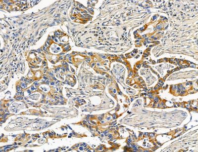 CMYA5 Antibody - DF14675 at 1/100 staining human pancreatic cancer and para-carcinoma tissue by IHC-P.