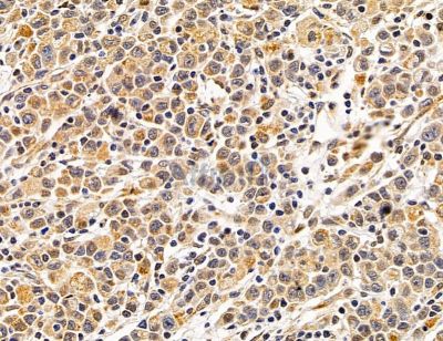 ZBTB1 Antibody - DF14703 at 1/100 staining human gastric cancer by IHC-P.