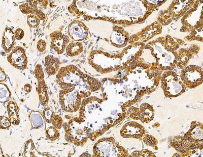 SHPRH Antibody - DF14707 at 1/100 staining human ovarian cancer by IHC-P.