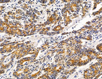 RNF170 Antibody - DF14713 at 1/100 staining human prostate cancer by IHC-P.