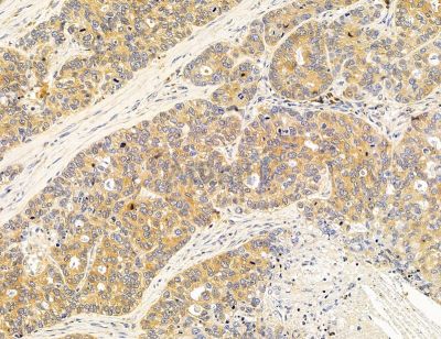 RHBDF1 Antibody - DF14722 at 1/100 staining human lung cancer by IHC-P.