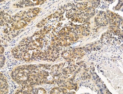 DDAH1 Antibody - DF14734 at 1/100 staining human lung cancer by IHC-P.