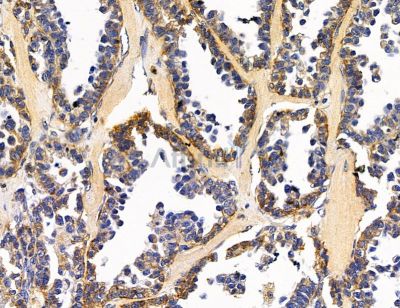 MINOS1 Antibody - DF14761 at 1/100 staining human ovarian cancer by IHC-P.