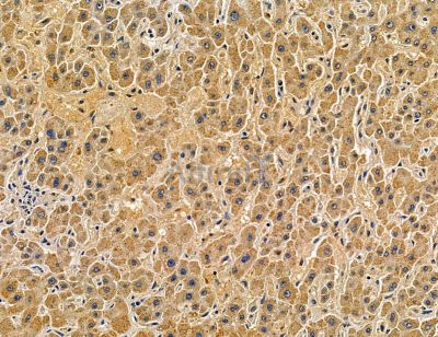 SIDT2 Antibody - DF14770 at 1/100 staining human prostate cancer and para-carcinoma tissue by IHC-P.