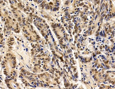 PHRF1 Antibody - DF14772 at 1/100 staining human colorectal cancer by IHC-P.