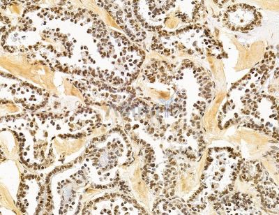 PHRF1 Antibody - DF14772 at 1/100 staining human ovarian cancer by IHC-P.