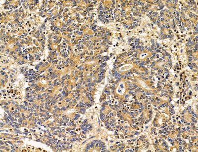 ASB9 Antibody - DF14878 at 1/100 staining human prostate cancer by IHC-P.
